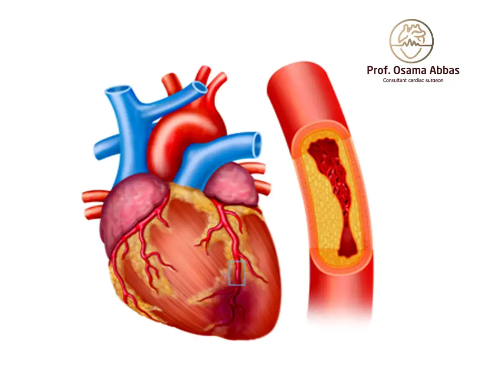 الشريان التاجي هو المسؤول عن تغذية عضلة القلب بالدم والأكسجين، وأي انسداد فيه يسبب أمراض القلب. 