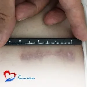 تغيير الصمام الأورطي بالتدخل المحدود