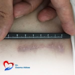 جراحة_اصلاح_او تغيير الصمام الميترالي بالمنظار بدون شق الصدر
