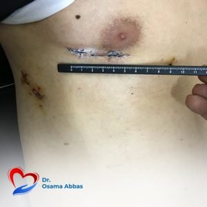 غلق الثقب بين الأذينين بالمنظار بدون شق الصدر