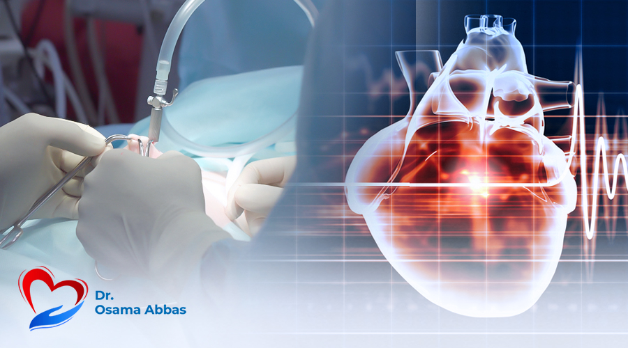 استئصال أورام القلب بالمنظار