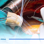 ما هي جراحة استبدال الصمامات بالقلب؟