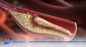 للشريان التاجي دور هام للغاية في حياة أي إنسان وهو توصيل الدم والأكسجين إلى عضلة القلب.إن أي قصور في الشريان التاجي يؤثر بالسلب على كفاءة القلب ويسبب الكثير من المشاكل والتي قد تؤدي في النهاية إلى الوفاة. معلومات عن الشريان التاجي إن هذا الشريان هو المسؤول الأول عن تغذية عضلة القلب بالدم والأكسجين، وتحيط الشرايين التاجية بعضلة القلب من الخارج ويتم تقسيمها على النحو التالي: الشريان التاجي الأيمن وهو المسؤول عن تغذية الجانب الأيمن من القلب، بجانب تغذية البطين الأيمن والأذين الأيمن. الشريان التاجي الأيسر وهو المسؤول عن تغذية الجانب الأيسر من القلب، بالإضافة إلى تغذية البطين الأيسر والأذين الأيسر. الشرايين التاجية الجانبية وهي شبكة من الأوعية الدموية تعمل في حالة ضيق أو انسداد أحد الشرايين التاجية أو انقطاع الدورة الدموية عن عضلة القلب، لتبدأ الشرايين بالعمل في هذه الحالة وإيصال الدم إلى عضلة القلب للحفاظ عليها. أعراض انسداد الشريان التاجي هناك العديد من الأعراض التي تشير للإصابة بانسداد الشريان التاجي ومنها: الشعور بألم في الصدر دون بذل أي مجهود القيء التعرق الشديد اضطرابات ضربات القلب بمجرد الشعور بـ أعراض انسداد الشريان التاجي، يجب التواصل فورًا مع الطبيب والانتقال للمستشفى من أجل تلقي العلاج المناسب، فكلما تلقى المريض العلاج مبكرًا زادت نسبة شفاءه. أسباب انسداد الشريان التاجي انسداد الشريان التاجي له العديد من الأسباب ومنها ما يلي: تاريخ عائلي سئ في أمراض القلب بشكل عام التدخين الارتفاع في ضغط الدم الإصابة بمرض السكري ومقاومة الأنسولين عدم ممارسة أي نشاط رياضي حتى ولو بشكل بسيط ارتفاع الكوليسترول في الدم الوزن الزائد (السمنة) العادات الغذائية الغير صحية كيف يتم تشخيص أمراض الشرايين التاجية؟ يوجد العديد من الوسائل التي يتم من خلالها تشخيص أمراض الشرايين التاجية: رسم القلب بالمجهود من خلال ممارسة المريض لجهد محسوب ومتابعة حالة ضغط الدم الموجات الصوتية على القلب والتي تعرف بمصطلح (الإيكو) ويتم استخدام هذا الصوت من الموجات، لتكوين صورة عن عضلة القلب، ليتمكن الطبيب من خلالها مشاهدة القلب أثناء عمله وتصوير النبض وعملية ضخ الدم. القسطرة التشخيصية وهي عبارة عن صبغة يتم حقنها في الشرايين التاجية لإظهار أي انسداد أو تجلطات. الأشعة المقطعية بالصبغة بحقن صبغة في الشرايين واللجوء للقسطرة التشخيصية عند وجود أي مشكلة. علاج أمراض الشرايين التاجية يختلف علاج مريض الشرايين التاجية من شخص لآخر، فالطبيب المختص هو الوحيد الذي يمكنه تحديد نوع العلاج الذي يحتاجه المريض على حسب كل حالة. طريقة العلاج الأولى: منح المريض أدوية دون أي تدخل جراحي إذا كان الانسداد بسيط في الشريان التاجي. طريقة العلاج الثانية: يلجأ الطبيب إلى تركيب دعامات عن طريق القسطرة لتوسيع الشريان من أجل مرور الدم بشكل طبيعي ووصوله إلى عضلة القلب في حالات الانسداد الشديد. طريقة العلاج الثالثة: في الحالات المتقدمة التي لم تستجب للدعامات قد يضطر الطبيب إلى عملية ترقيع الشرايين التاجية. نصائح مهمة لمرضى الشريان التاجي المتابعة مع الطبيب المعالج بصفة مستمرة لتقييم الحالة ومعرفة آخر المستجدات. الامتناع عن التدخين اتباع نظام غذائي صحي بمعرفة الطبيب المعالج ممارسة نشاط رياضي بسيط بشكل يومي عدم التعرض للانفعالات الشديدة أو بذل مجهود زائد ينصح الدكتور أسامة عباس مرضاه بأهمية التوجه إلى استشاري أمراض القلب والشرايين عند ملاحظة أي أعراض غير طبيعية لعلاج المشكلة مُبكرًا وتجنب الحاجة إلى إجراء الجراحة.