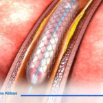عملیة تركیب دعامة الشریان الاورطي 