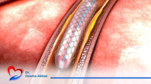 تركيب دعامة الشريان الاورطي