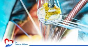 عملية تغيير الصمام الميترالي