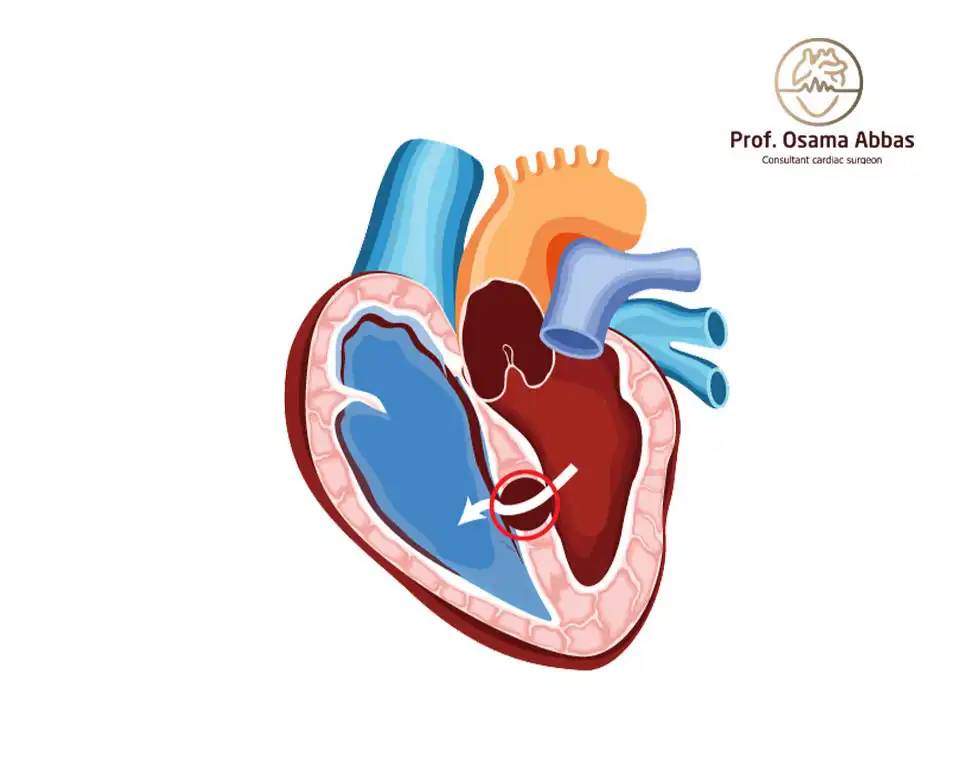 صورة توضح الثقب بين البطينين
