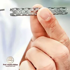 دعامة معدنية تُبقي الشريان مفتوحًا واسعًا يتدفق الدم خلاله بانسيابية