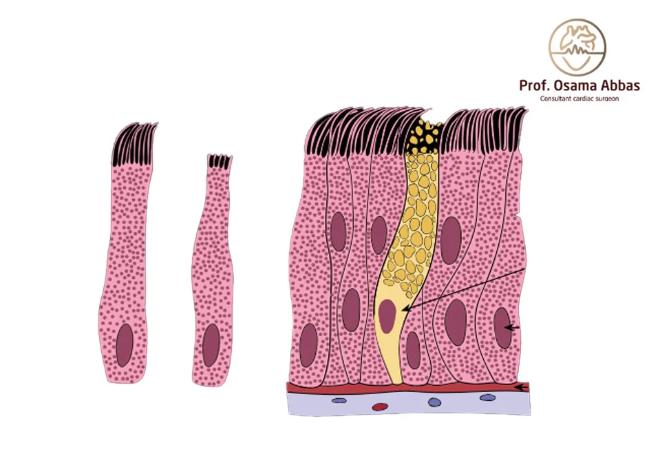 صمامٍ نسيجي مصنوع من الأنسجة الحيوانية
