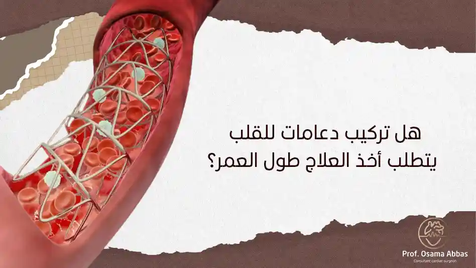 هل تركيب دعامات للقلب يتطلب أخذ العلاج طول العمر