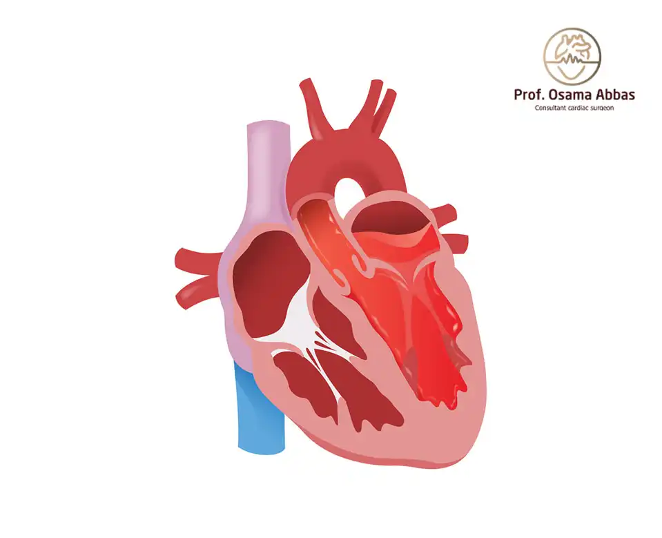 ارتجاع الصمام الميترالي
