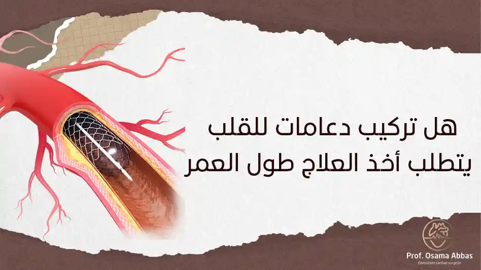 هل تركيب دعامات للقلب يتطلب أخذ العلاج طول العمر هل تركيب دعامات للقلب يتطلب أخذ العلاج طول العمر